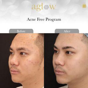 Acne-free-Program-1-650x650