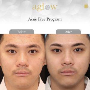 Acne-free-Program-2-650x650