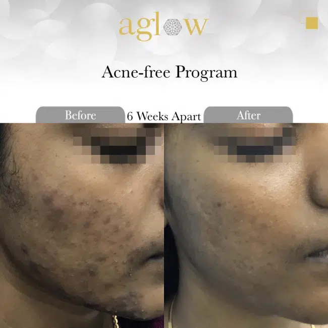 Acne-free-Program-6-650x650
