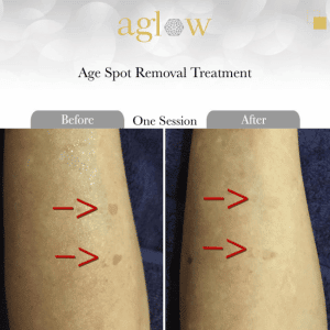 Age-Spot-Removal-Treatment-650x650