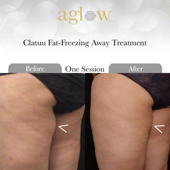 Clatuu-Freezing-Fat-Away-Treatment-1-650x650