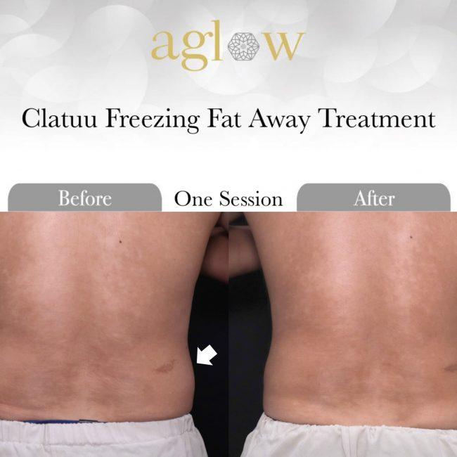 Clatuu-Freezing-Fat-Away-Treatment-2-650x650