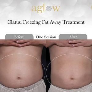 Clatuu-Freezing-Fat-Away-Treatment-4-650x650