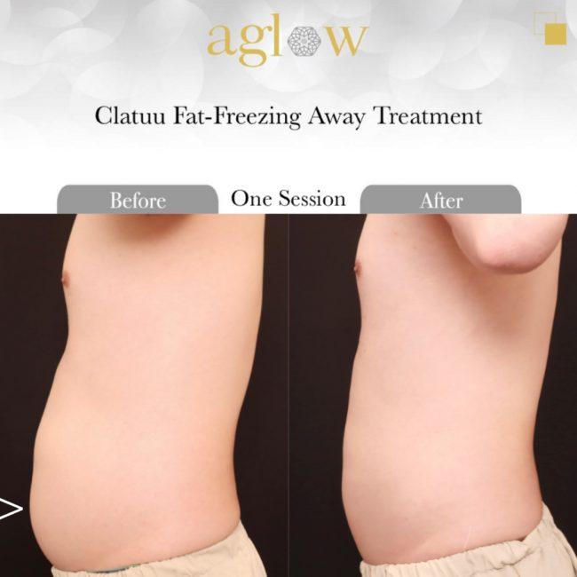 Clatuu-Freezing-Fat-Away-Treatment-6-650x650