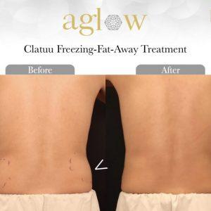 Clatuu-Freezing-Fat-Away-Treatment-7-650x650