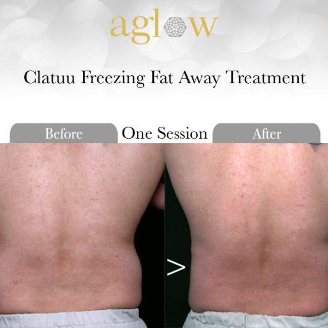 Clatuu-Freezing-Fat-Away-Treatment-8-650x650