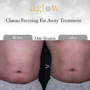 Clatuu-Freezing-Fat-Away-Treatment-9-650x650