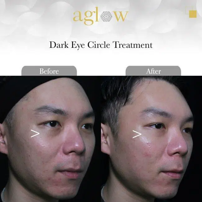 Dark-Eye-Circle-Treatment-2-650x650