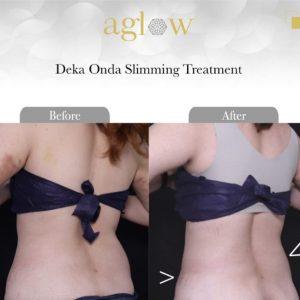 Deka-Onda-Slimming-Treatment-1-650x650