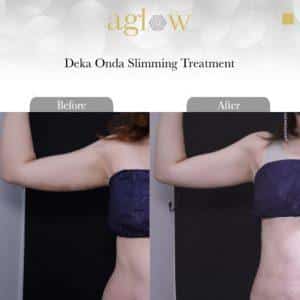 Deka-Onda-Slimming-Treatment-2-650x650