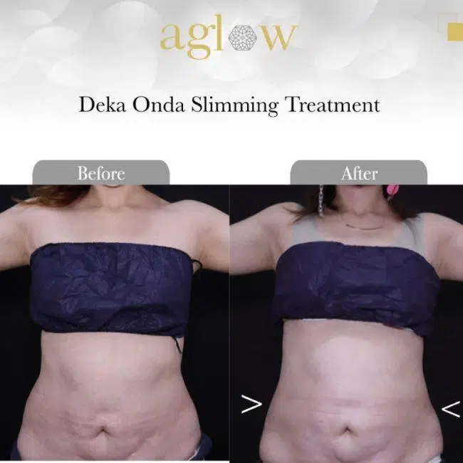 Deka-Onda-Slimming-Treatment-3-650x650