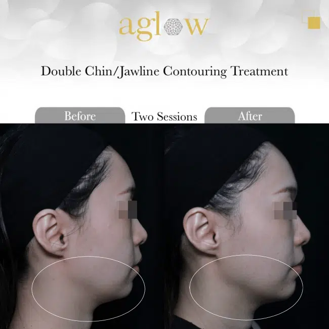 Double-Chin-Jawline-Contouring-Treatment-650x650