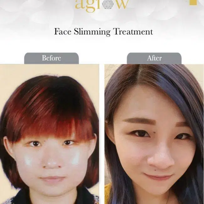 Face-Slimming-Treatment-1-650x650