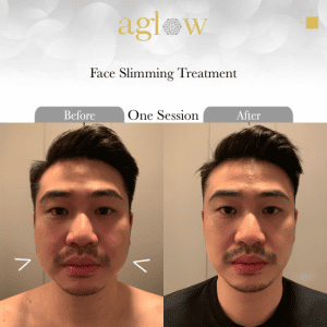 Face-Slimming-Treatment-2-650x650