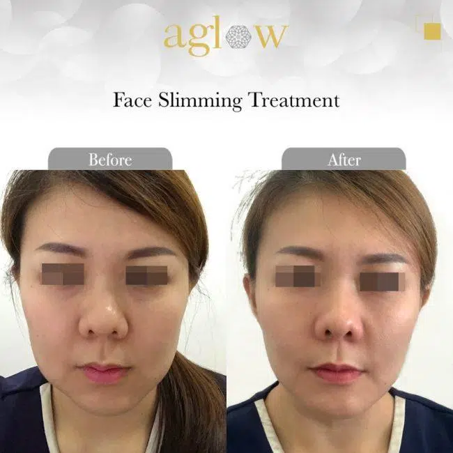 Face-Slimming-Treatment-4-650x650