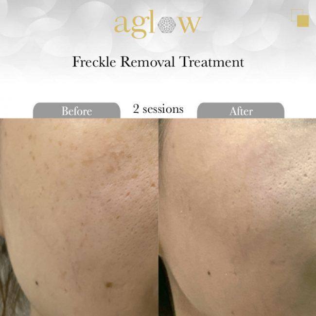 Freckle-Removal-Treatment-2-650x650