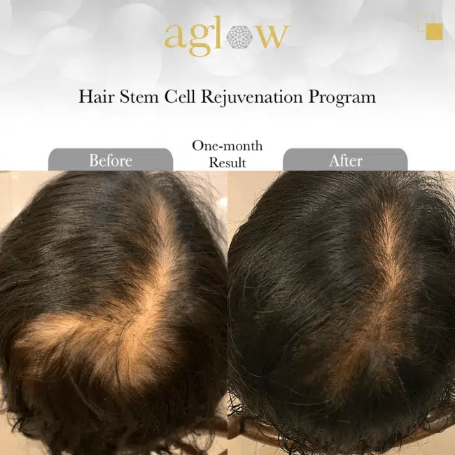 Hair-Stem-Cell-Rejuvenation-Program-1-650x650