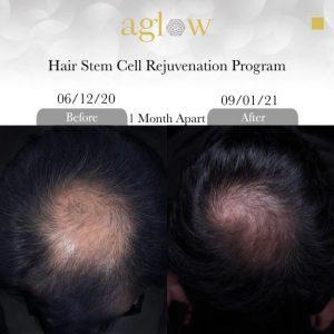 Hair-Stem-Cell-Rejuvenation-Program-2-650x650