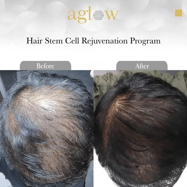 Hair-Stem-Cell-Rejuvenation-Program-2-650x650