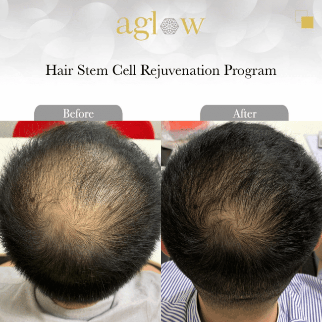 Hair-Stem-Cell-Rejuvenation-Program-3-650x650