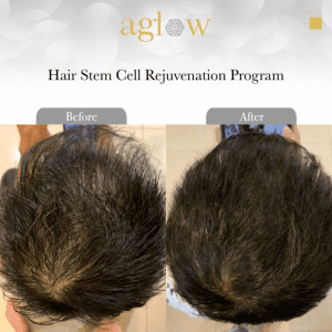 Hair-Stem-Cell-Rejuvenation-Program-4-650x650