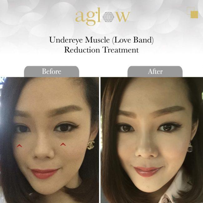 Undereye-Muscle-Love-Band-Reduction-Treatment-650x650